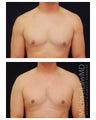 Gynecomastia