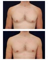 Gynecomastia