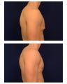 Gynecomastia 