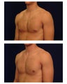 Gynecomastia 