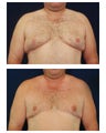 Gynecomastia