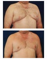 Gynecomastia
