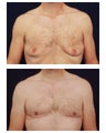 Gyencomastia