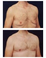 Gynecomastia