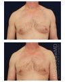 Gynecomastia