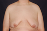 Gynecomastia