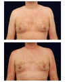 Gynecomastia