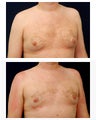 Gynecomastia