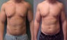 Gynecomastia 