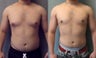 Gynecomastia 