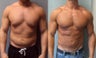 Gynecomastia 