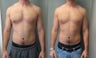 Gynecomastia 