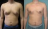  Gynecomastia 