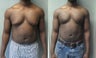 Gynecomastia 