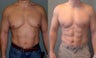  Gynecomastia 
