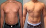 Gynecomastia 