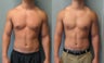 Gynecomastia 
