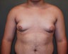 Male Breast Reduction