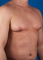 Gynecomastia 
