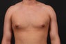 Gynecomastia