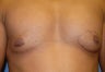 Male Breast Reduction