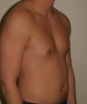 Male Breast Reduction