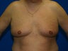 Male Breast Reduction (Gynecomastia Treatment)