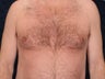 Liposuction and ultra-sonic liposuction to the chest for gynecomastia