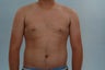 gynecomastia treatment