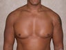 gynecomastia treatment