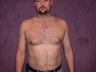 gynecomastia treatment