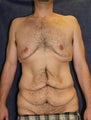 Male Breast Reduction - Gynecomastia