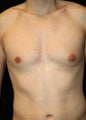 Male Breast Reduction