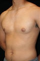 Male Breast Reduction