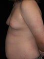 Male Breast Reduction