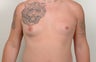 Gynecomastia with Vaser Liposuction