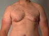 gynecomastia