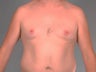 gynecomastia