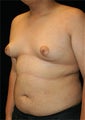 Male Breast Reduction