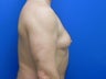 Male Gynecomastia Reduction