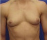 Male Breast Reduction