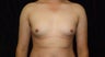 Gynecomastia 