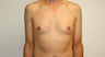 Gynecomastia 
