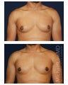 Gynecomastia
