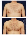 Gynecomastia