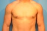 Gynecomastia