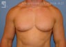 Gynecomastia (Male Breast Reduction)