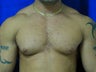 Male Breast Reduction