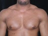 Male Breast Reduction