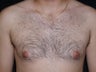 Male Breast Reduction